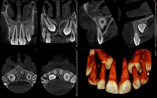 Planmeca Ultra Low Dose